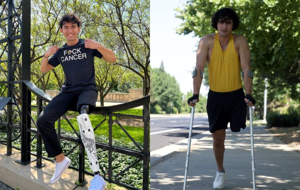Side by side of Alex Parra wearing a silver prosthetic leg and giving a thumbs up, next to him on crutches with no prosthetic.